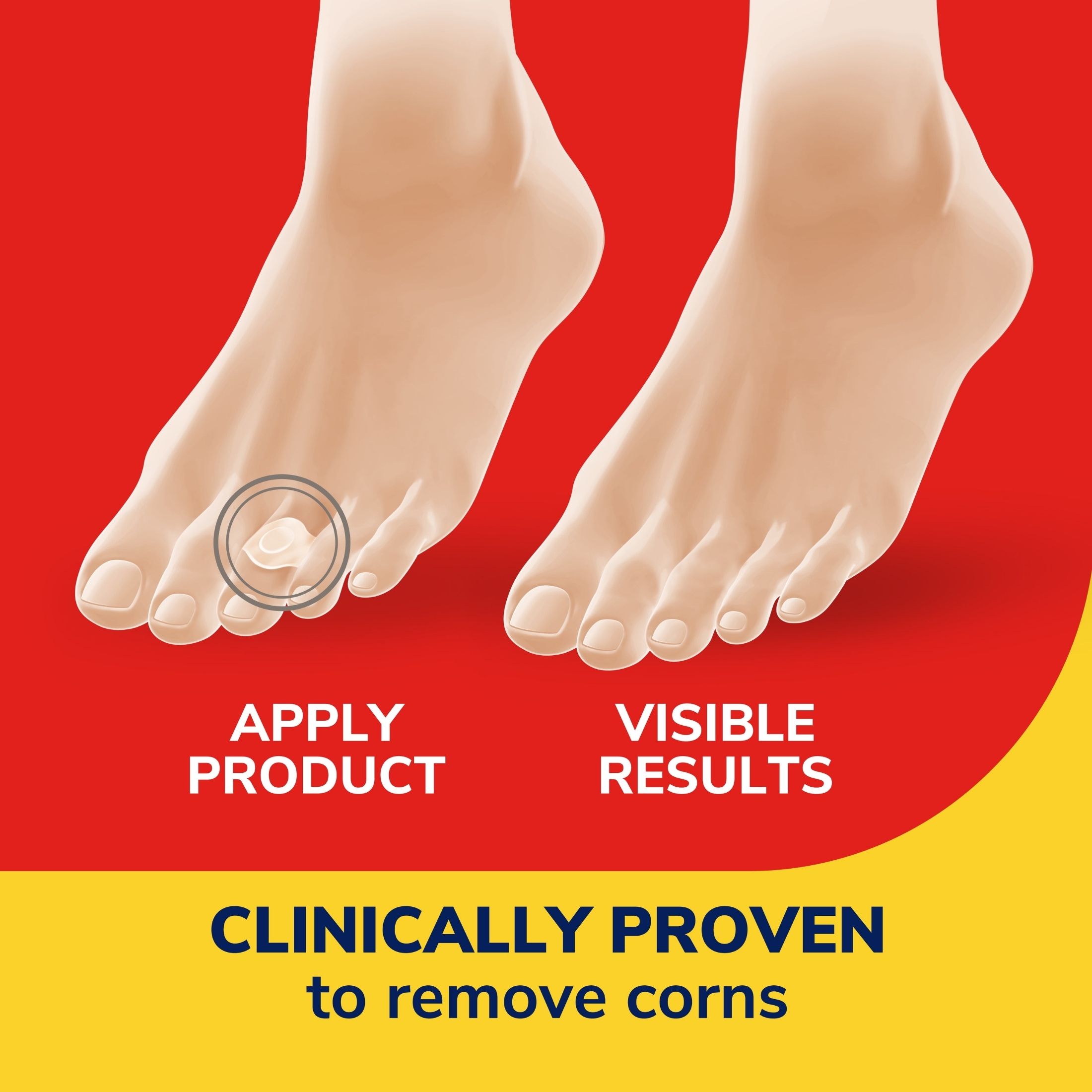 Dr. Scholl's Maximum Strength One Step Corn Removers 6 Bandages