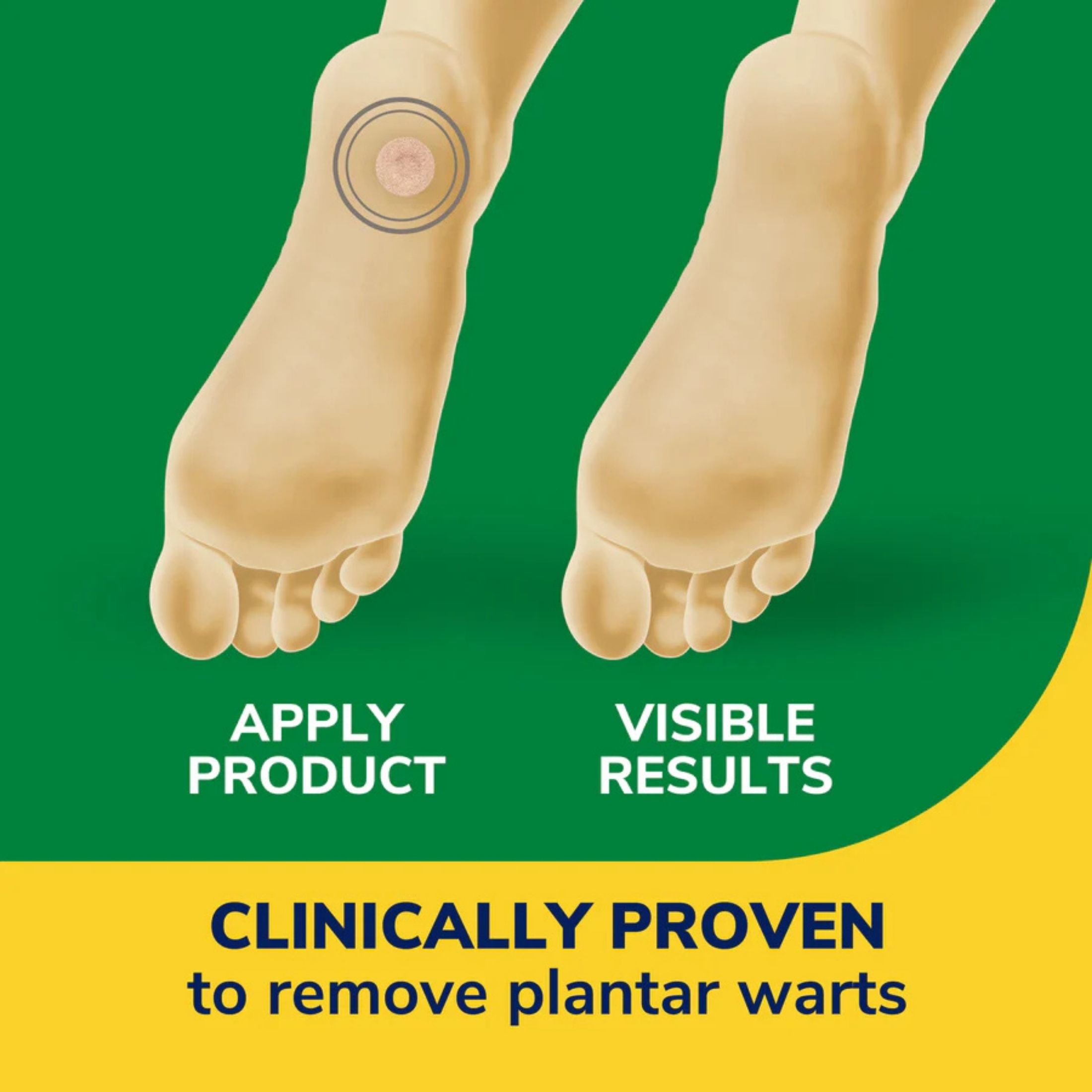 Dr. Scholl's Clear Away Plantar Wart Removers Maximum Strength Medicated Discs