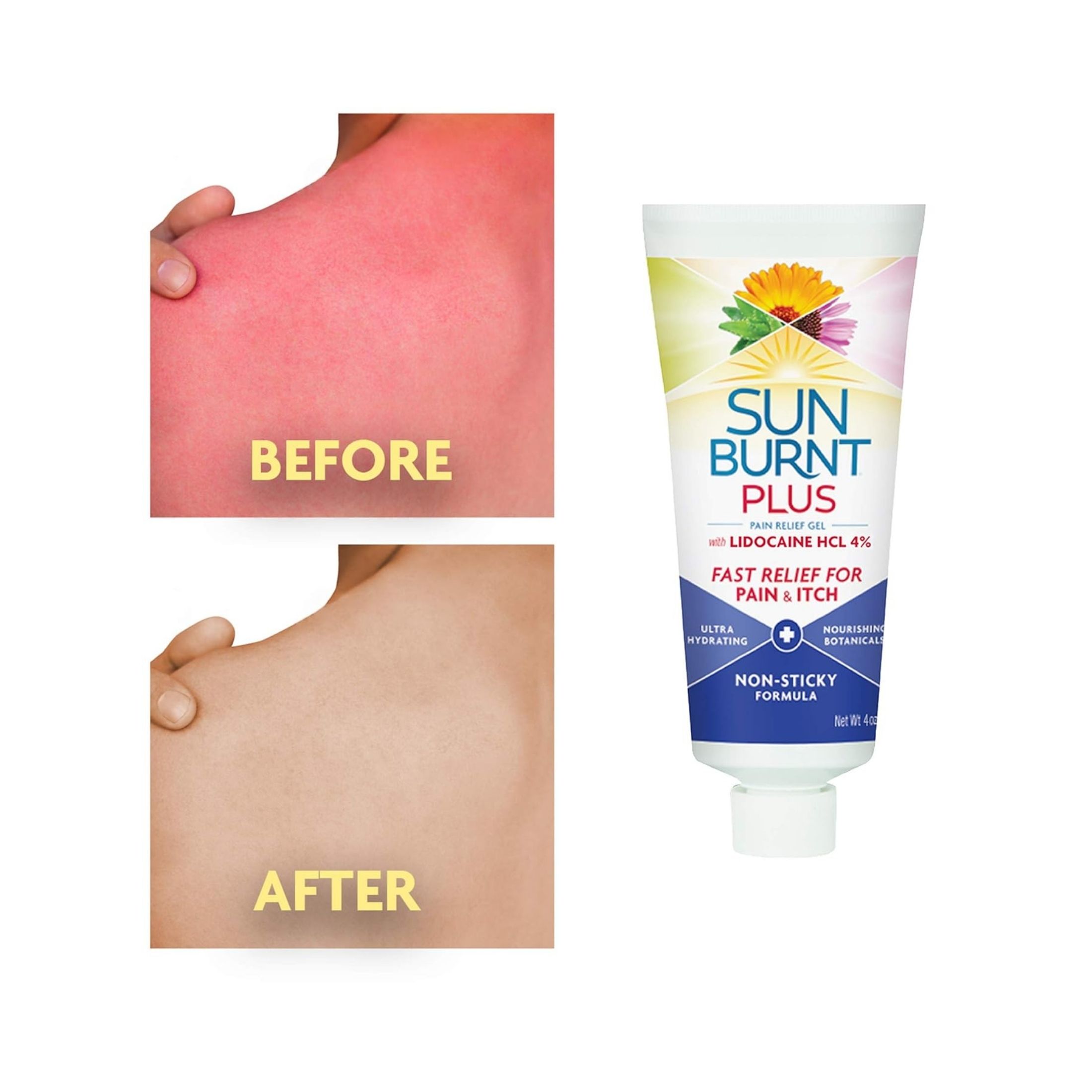 SunBurnt Plus Pain Relief Gel With Lidocaine HCL 4% 4 Oz