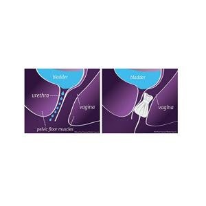 Poise Impressa Bladder Supports, Sizing Kit