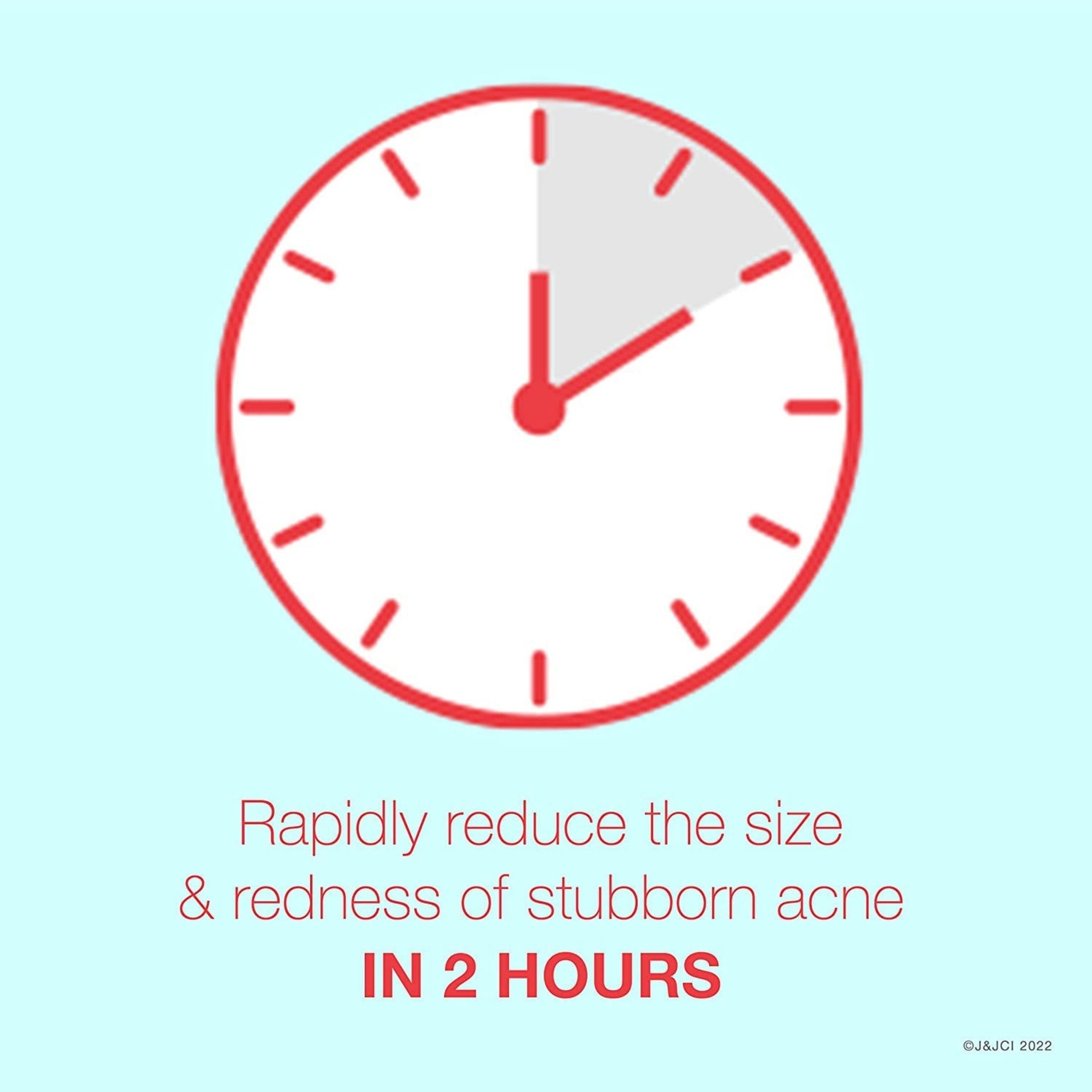 Neutrogena Rapid Clear Stubborn Acne Medication Spot Treatment Gel - 1 Oz