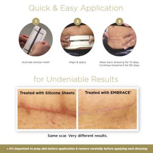 Embrace Active Scar Defense Silicone Sheets For New Scars 30 Folhas
