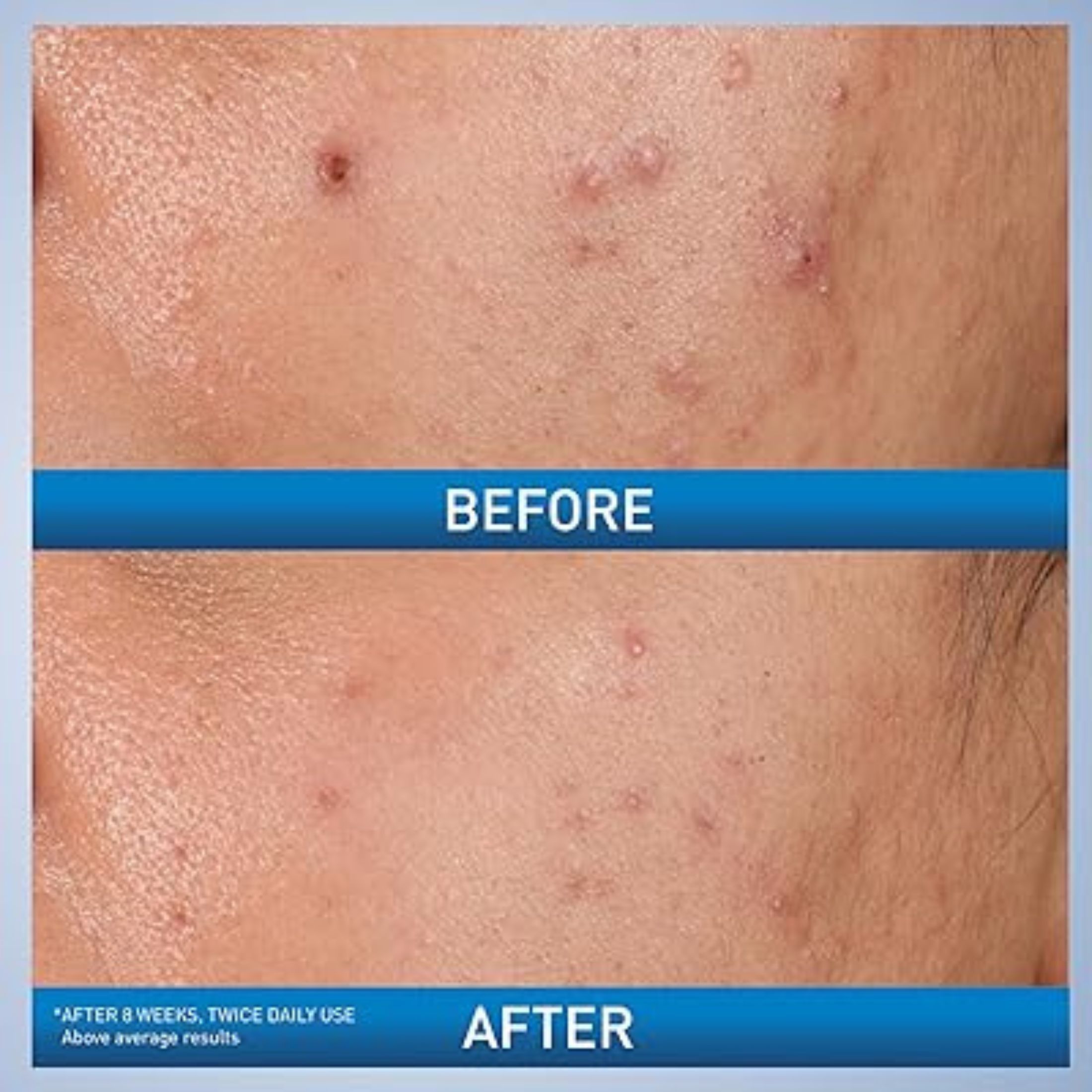 Cerave Acne Control Gel